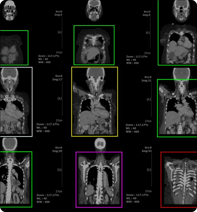 Get the Right Diagnosis & Treatment through X-ray Film Classification with Vision AI